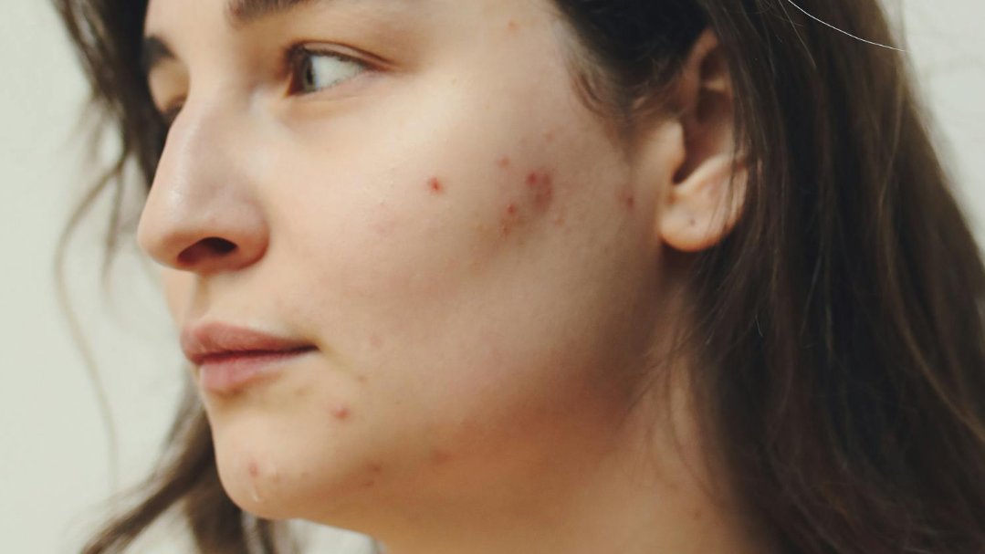 Tratamiento para Piel Grasa o Acnéica - Foto 1